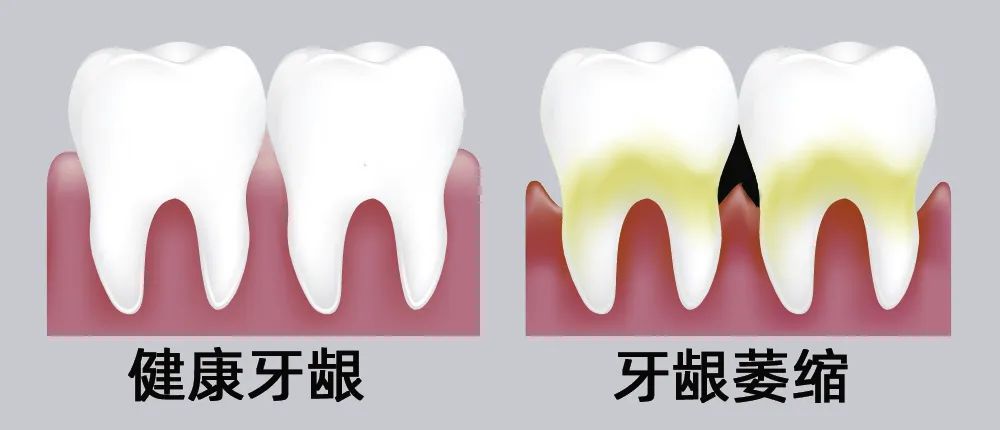 牙縫大露出“黑三角”，既塞牙又難看！還能恢復嗎？